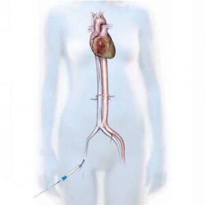 Femoral cannulas for extracorporeal circuit